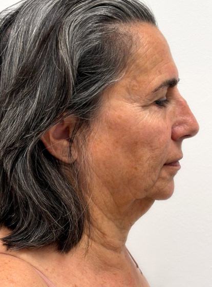 Facial + cuello · perfil derecho antes