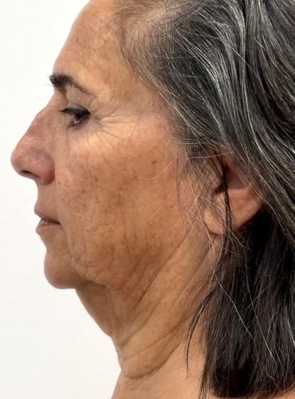 Facial + cuello · perfil izquierdo antes