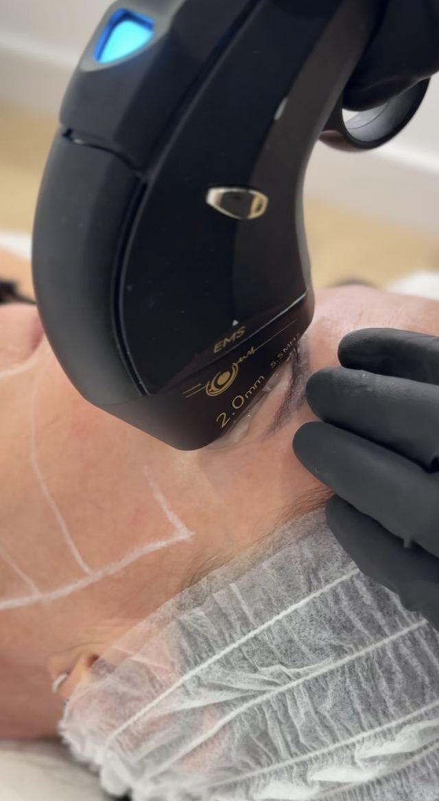 Tercio facial
