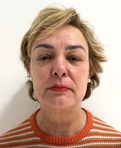 Facial completo después