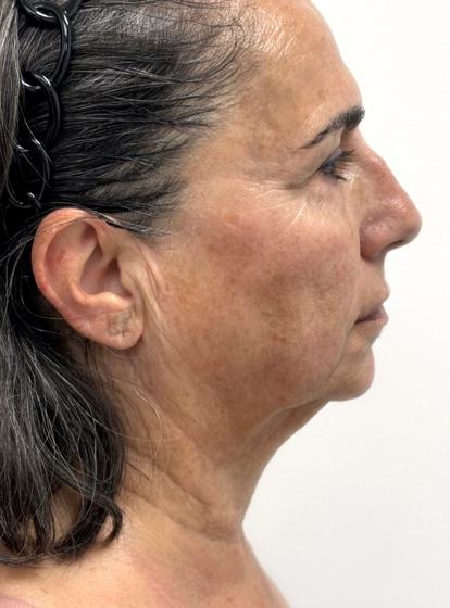 Facial + cuello · perfil derecho después