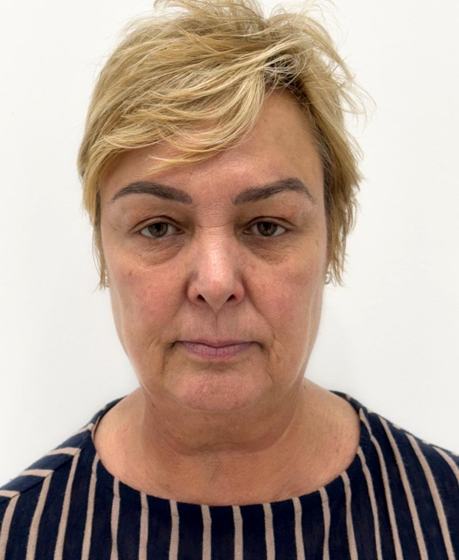 Facial completo antes