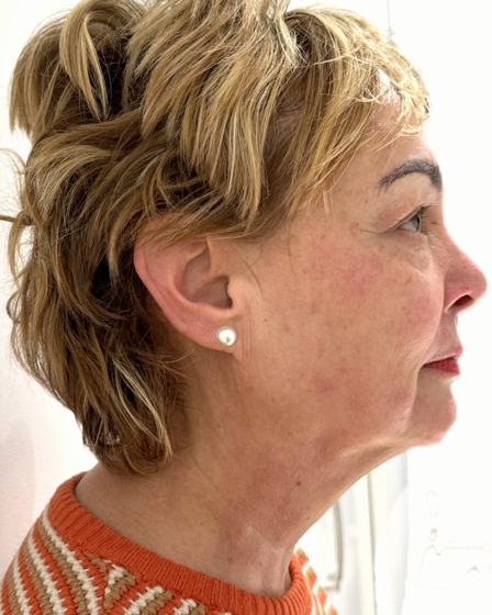 Cuello y papada después