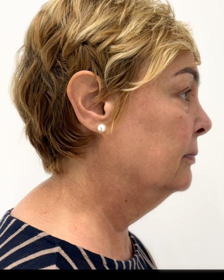 Cuello y papada antes