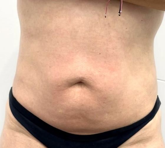 Abdomen después
