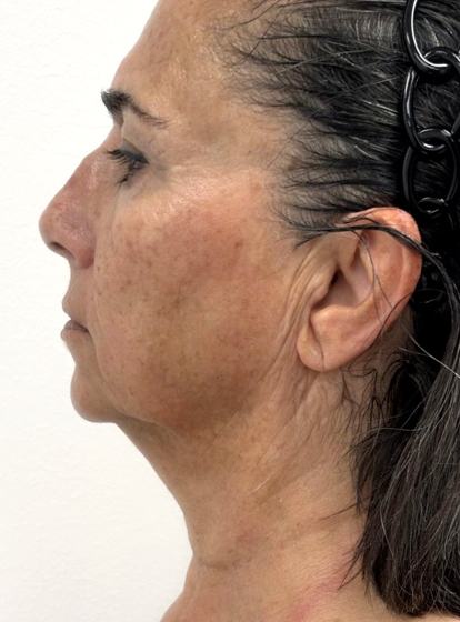 Facial + cuello · perfil izquierdo después