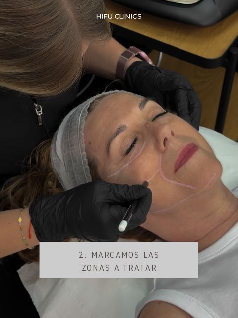 Marcamos las zonas a tratar