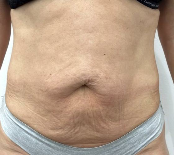 Abdomen antes