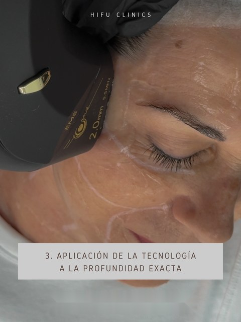 Aplicación de la tecnología HIFU