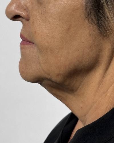 Papada y cuello · perfil antes