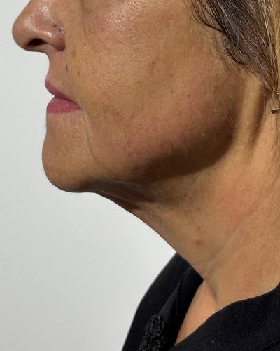 Papada y cuello · perfil después